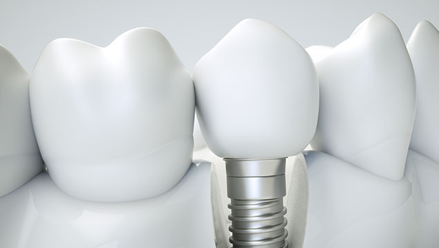 trattamenti-implantologia