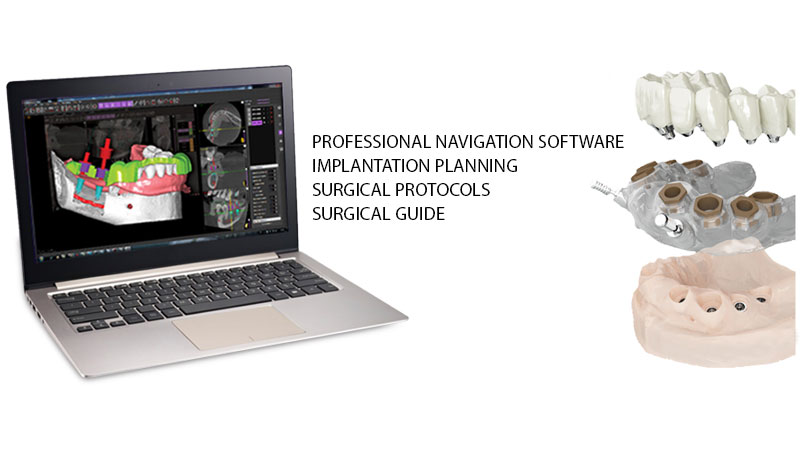 implantologia_chirurgia_guidata